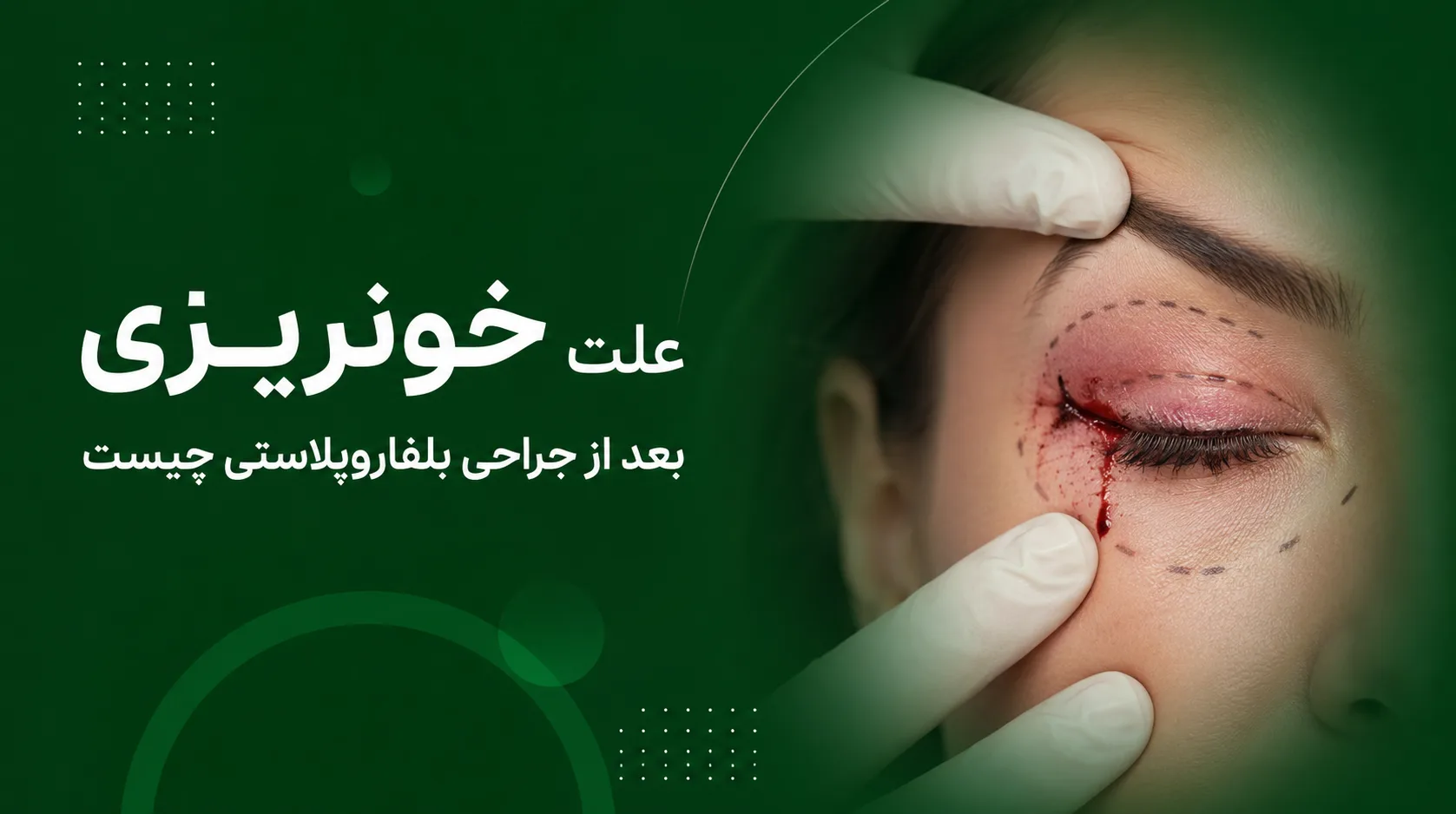 علت خونریزی بعد از جراحی بلفاروپلاستی چیست