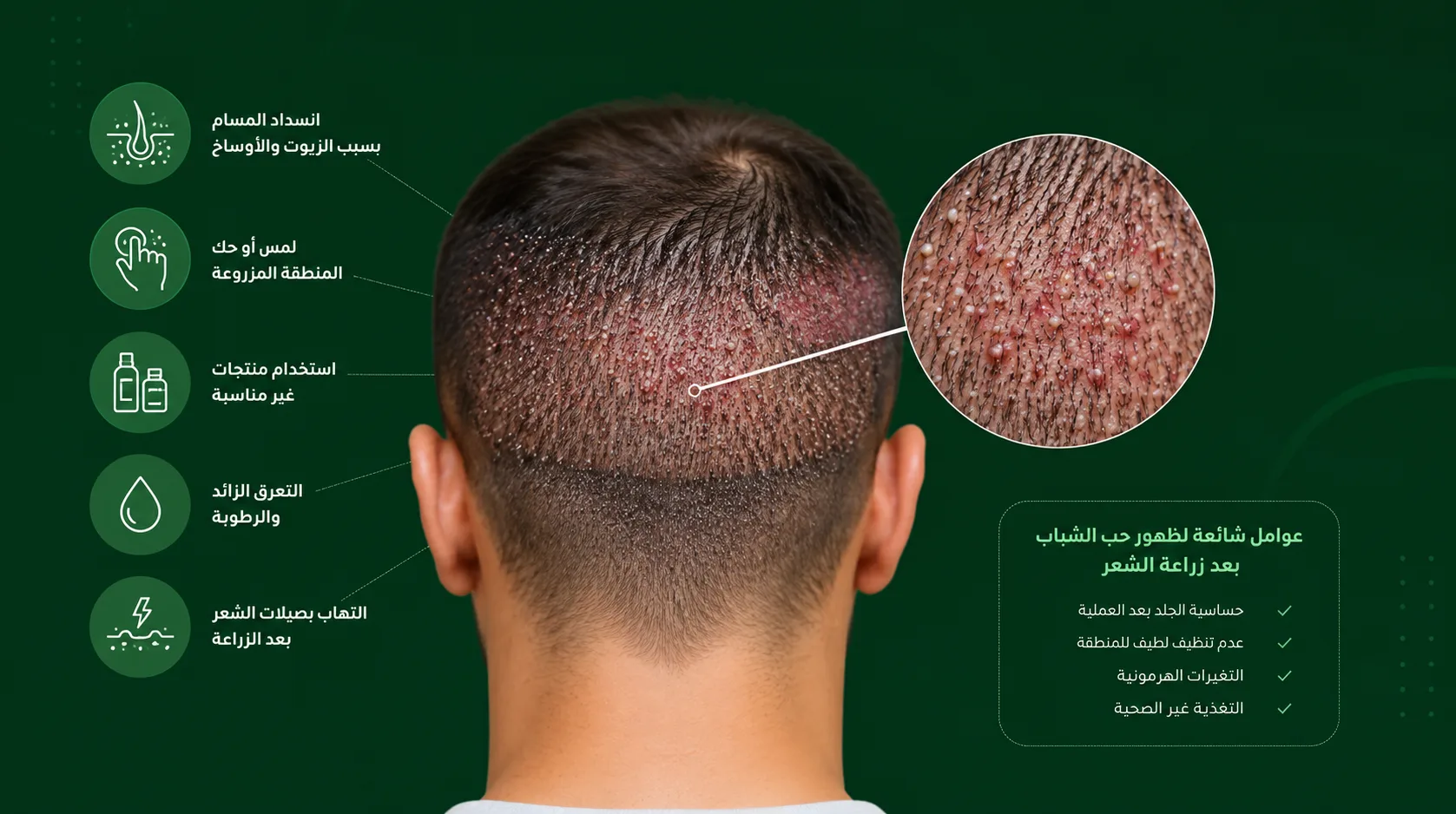 أسباب ظهور حب الشباب في منطقة زراعة الشعر بعد العملية