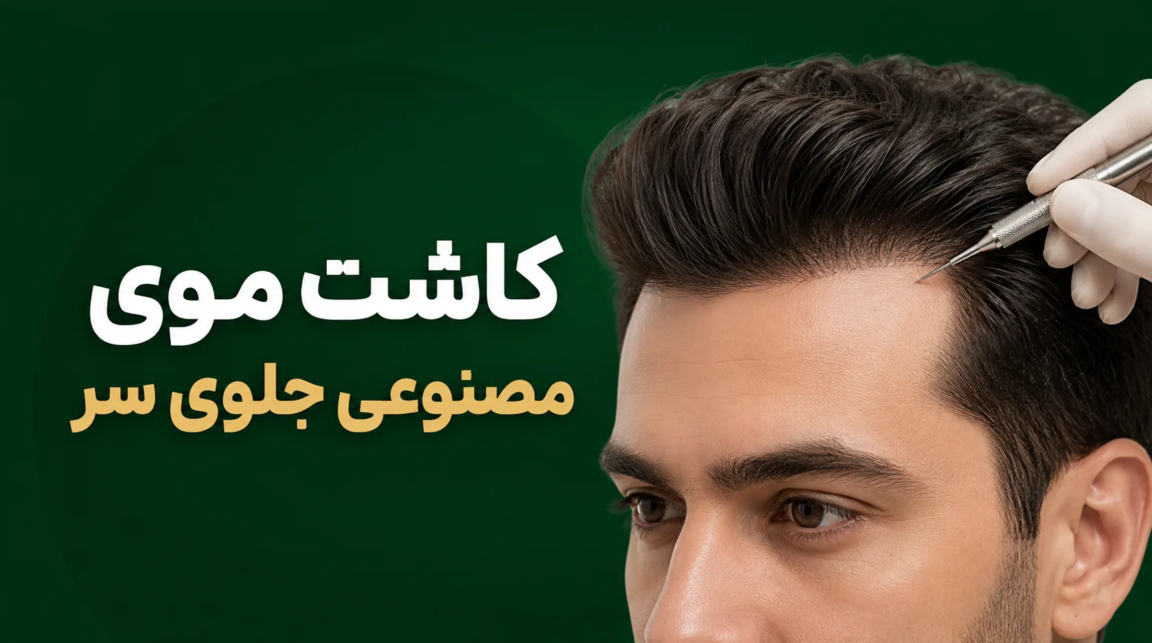 کاشت موی مصنوعی جلوی سر