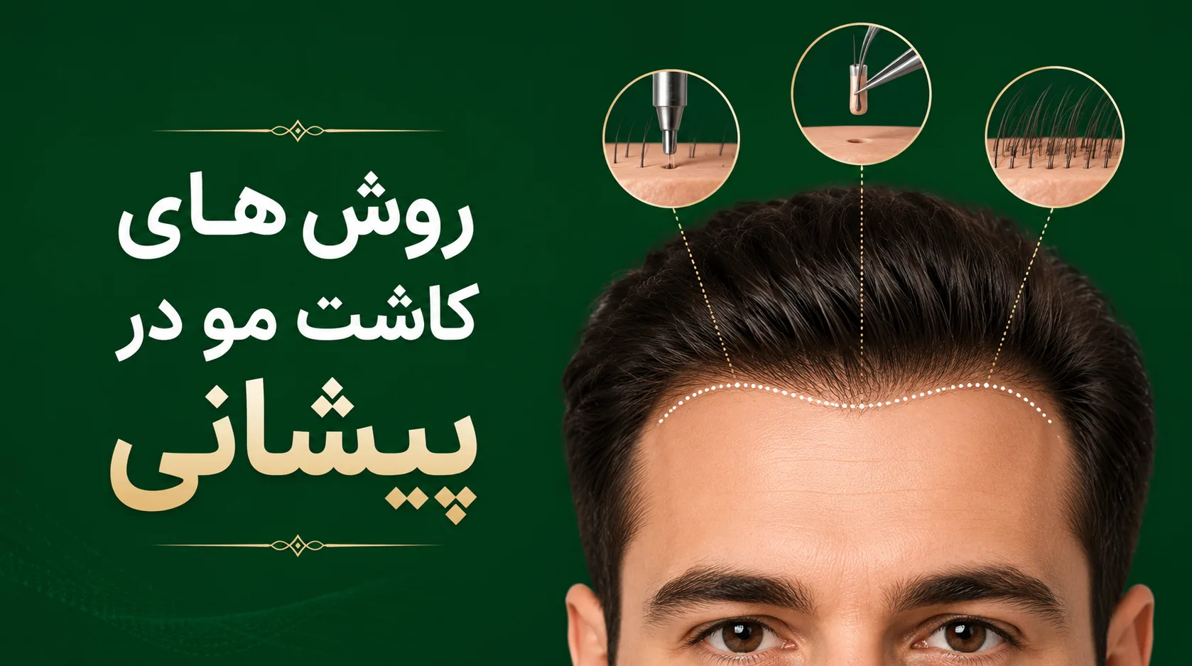 روش های کاشت مو در پیشانی