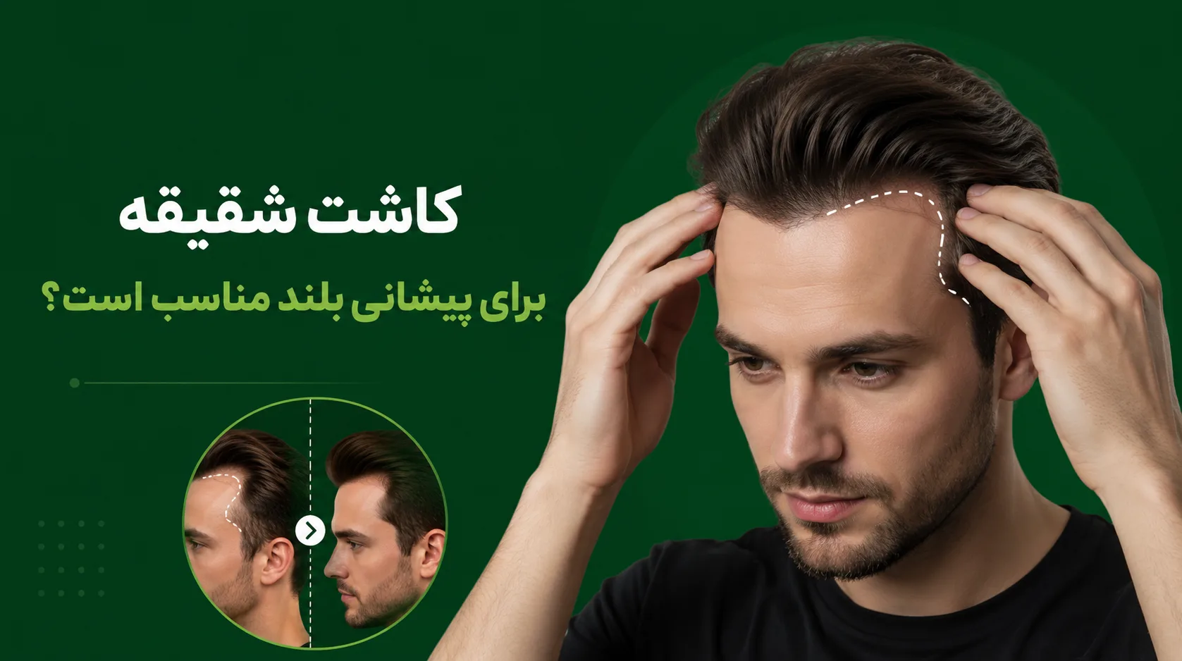 آیا کاشت شقیقه برای پیشانی بلند مناسب است؟