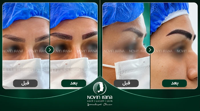 عکس قبل و بعد میکرو کاشت ابرو