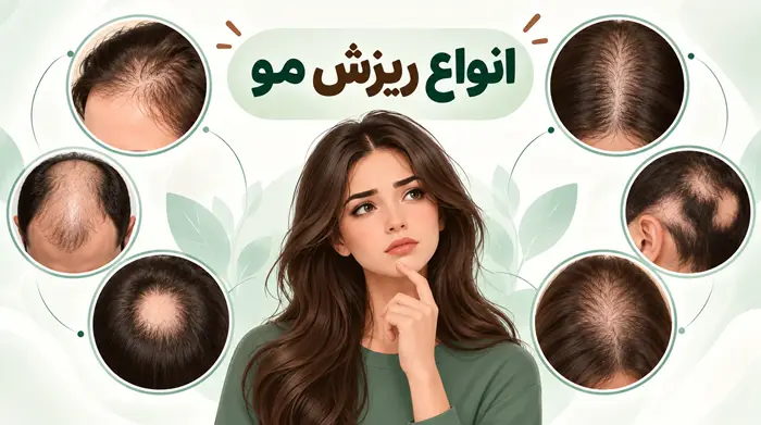انواع ریزش مو
