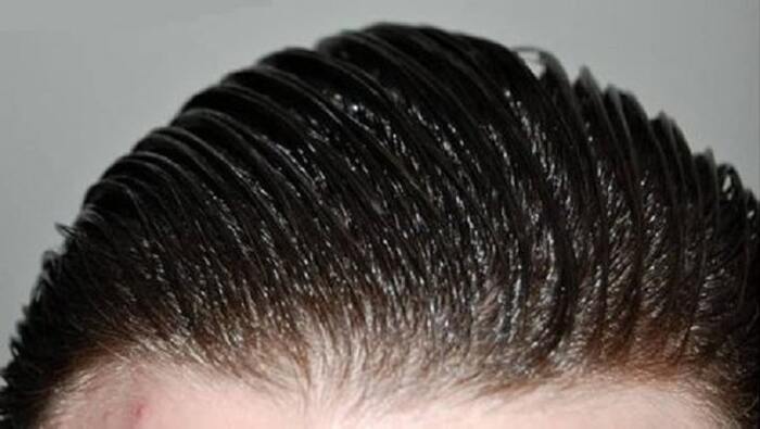 عوامل تشدید چربی پوست سر پس از کاشت مو