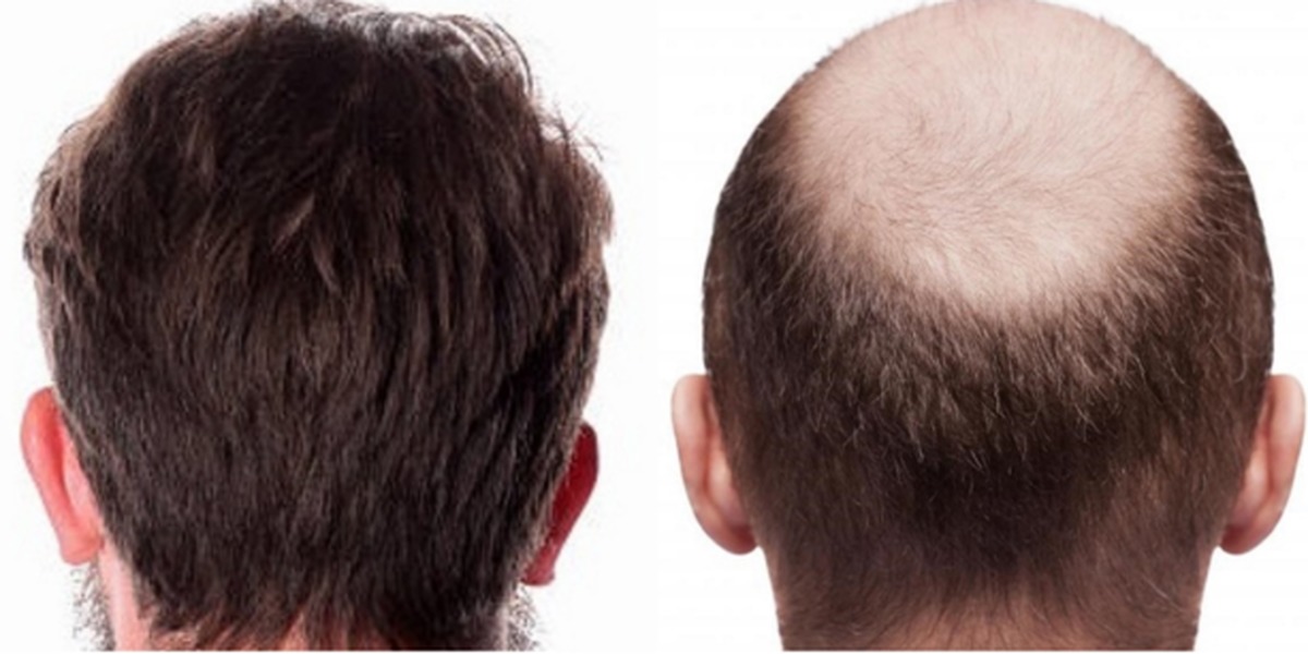 تفاوت کاشت مو با روش های Fut و Fue 