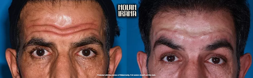 قبل و بعد سابسیژن