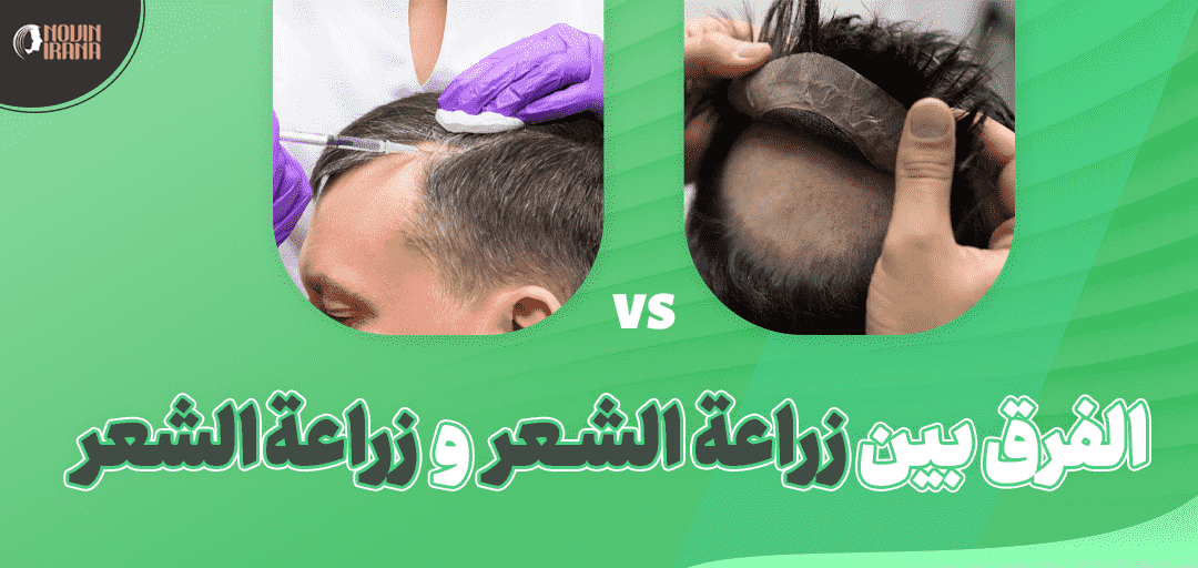 الفرق بين زراعة الشعر و بدلة الشعر