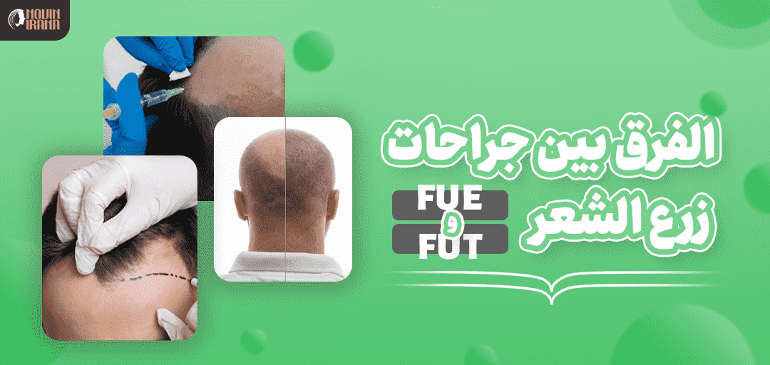 الفرق بين زراعة الشعر FUE و FUT